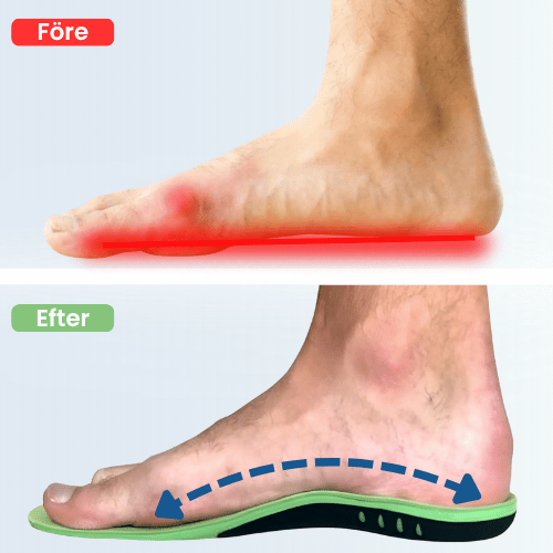 Medisole Hallux Valgus